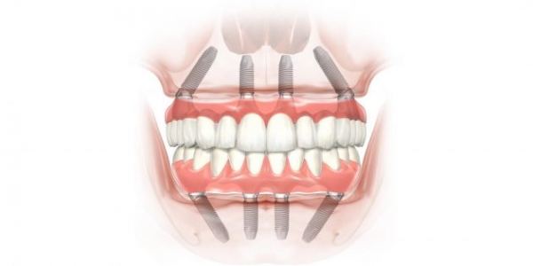 Как восстановить зубы и вернуть улыбку
